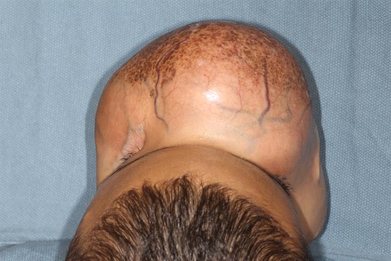 Cirujanos extirparán un tumor facial de 4,5 kilos a un niño cubano en Miami (imágenes sensibles)