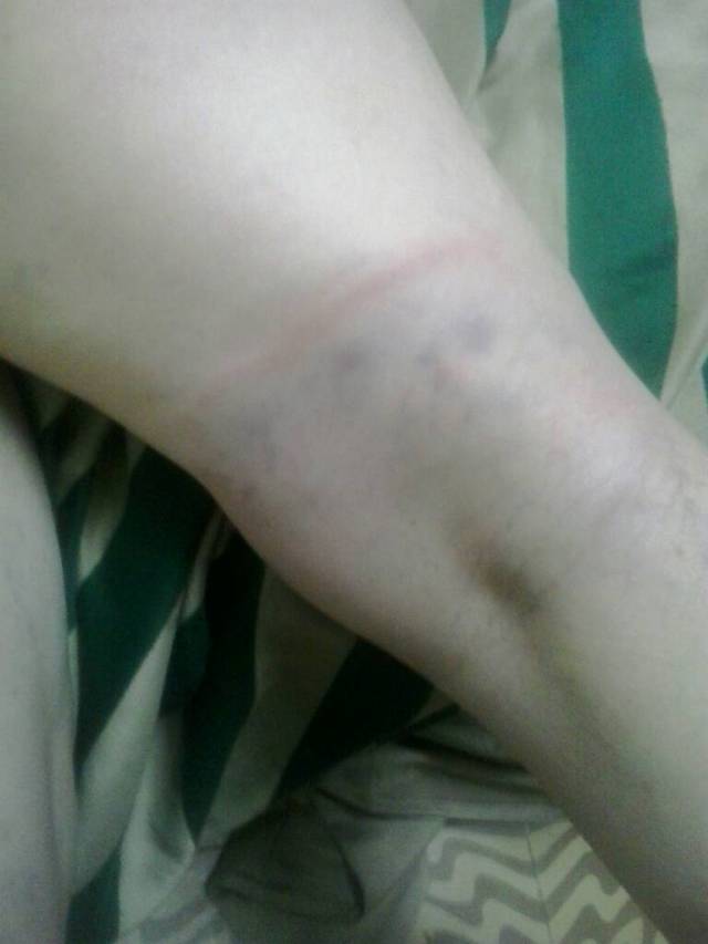Este es la pierna de la señora Xiomara Barreto, victima de la represión de los efectivos de seguridad. Foto cortesía. . 