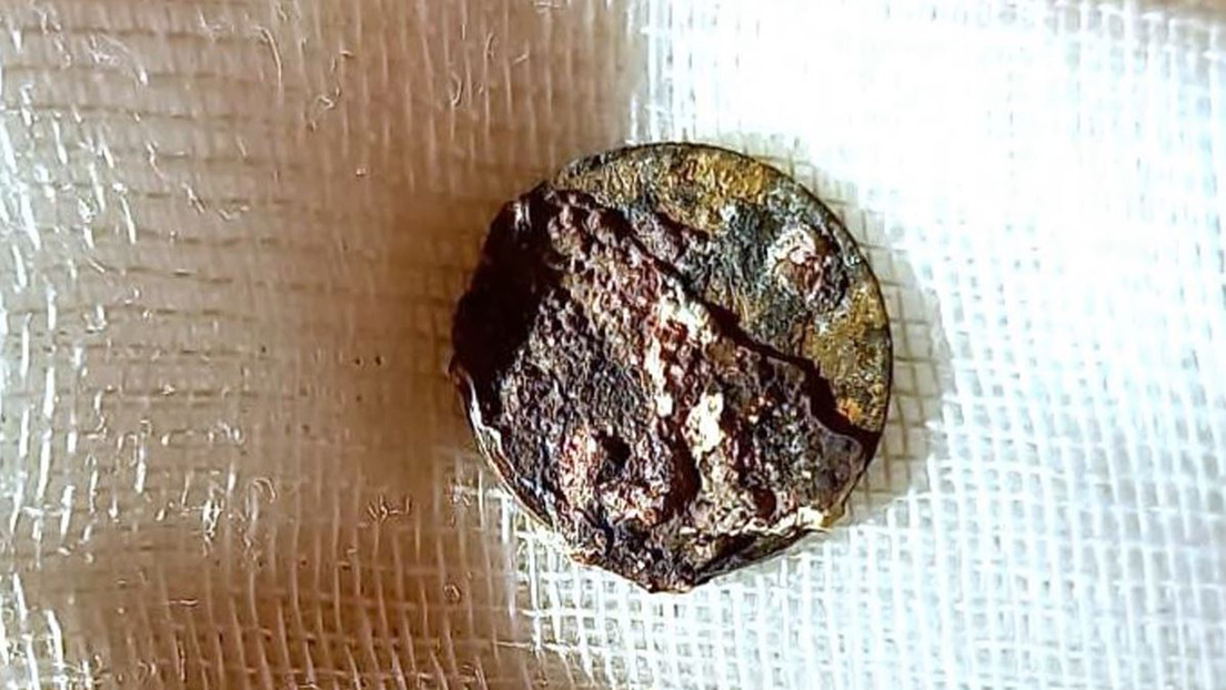 Grabaron cómo le extrajeron una moneda que se introdujo en la nariz hace 53 años (Video)