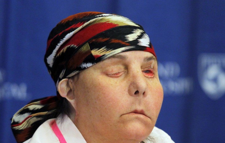 La primera persona en recibir dos trasplantes de cara en EEUU muestra su rostro (FOTO)