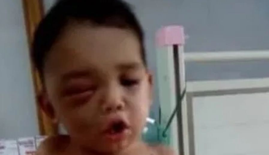 Conmoción en Lara: Bebé de un año fue mordido en la cara por una mapanare (FOTO)