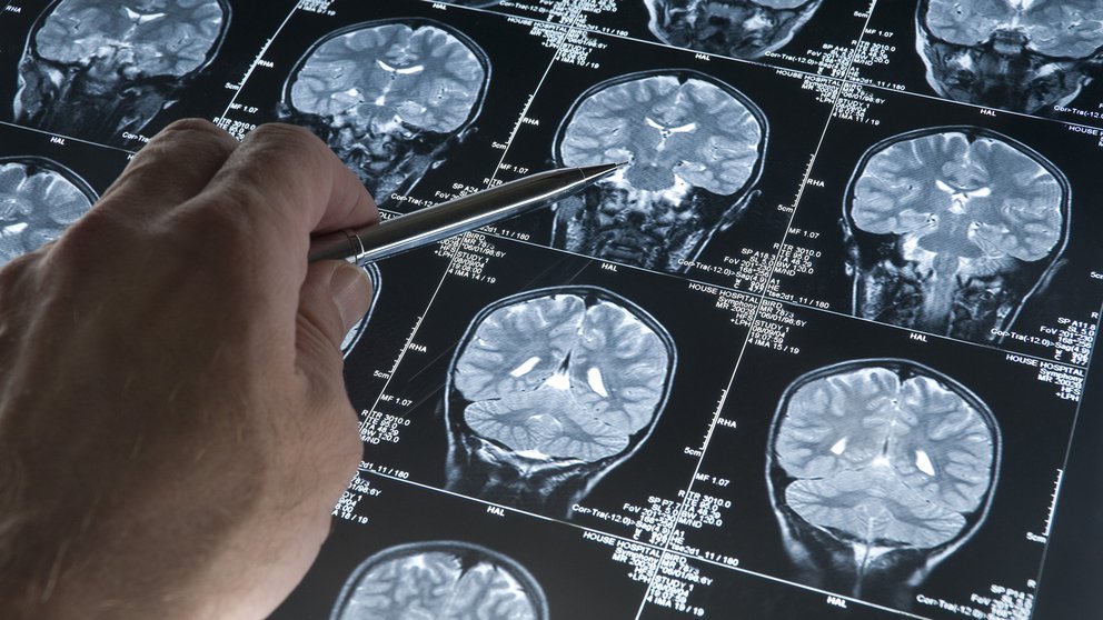 Laboratorio de EEUU comenzará a distribuir nuevo fármaco contra el alzhéimer en dos semanas