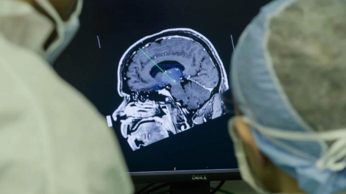 Un implante cerebral que elimina los pensamientos negativos genera controversia en la comunidad científica
