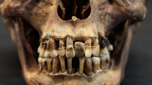Arqueólogos descubren un “secreto dorado” en la boca de una aristócrata del siglo XVII (FOTOS)