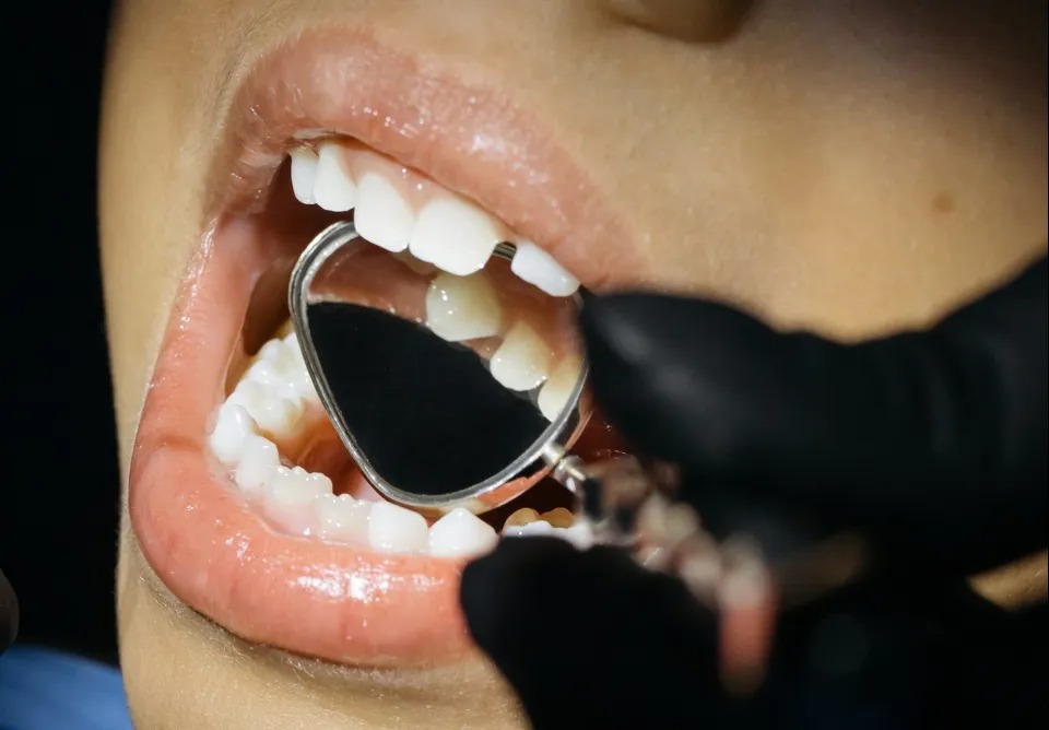 El extraño caso de la niña que nació con 81 dientes y se ha convertido en un reto para los dentistas
