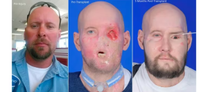 Hombre recibe con éxito el primer trasplante de ojo completo en el mundo